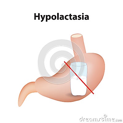 Hypolactasia. Lactose intolerance. Stomach. A glass of milk. Infographics. Vector illustration on isolated background Vector Illustration