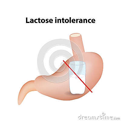 Hypolactasia. Lactose intolerance. Stomach. A glass of milk. Infographics. Vector illustration on isolated background Vector Illustration