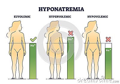 Hyponatremia body condition with low sodium salt level outline diagram Vector Illustration