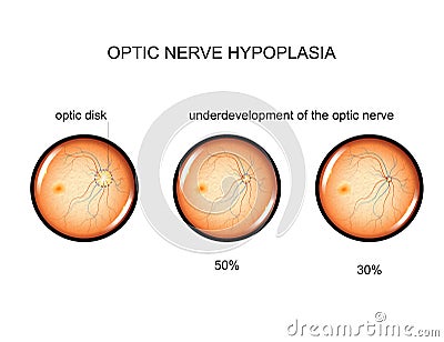 Hypoplasia of the optic nerve Vector Illustration