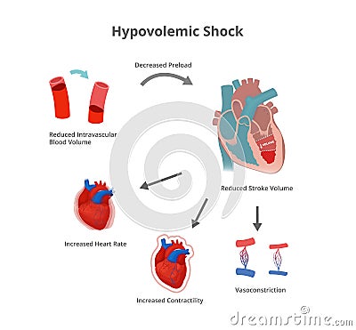 Hypovolemic shock pathology. Compensatory mechanisms of hypovolemic shock Vector Illustration