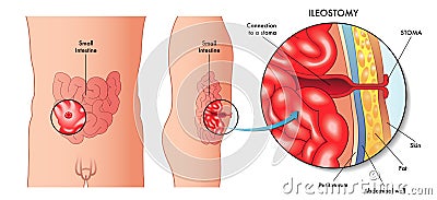 Ileostomy Vector Illustration