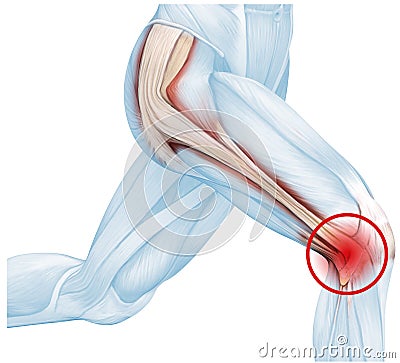 Iliotibial band syndrome, painful knee joint, inflammation or overuse. Illustration Stock Photo