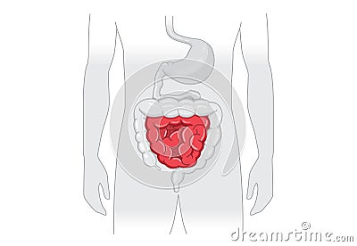 Illustration about abnormal symptom of human small Intestines. Vector Illustration