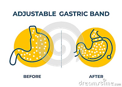 Illustration of Adjustable Gastric Band devise Weight Loss Surgery vector Vector Illustration