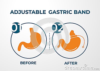 Illustration of Adjustable Gastric Band devise Weight Loss Surgery vector Vector Illustration