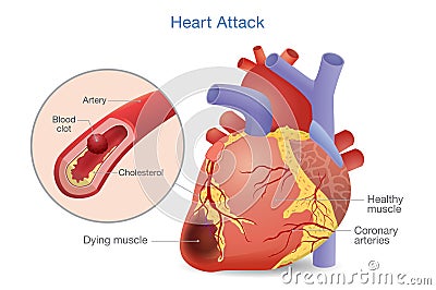 Illustration of Arterial thrombosis is a blood clot that develops to heart attack. Vector Illustration