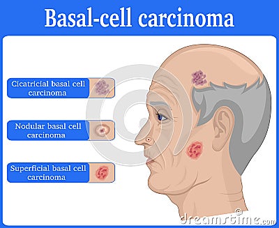 Illustration of Basal cell carcinoma Vector Illustration