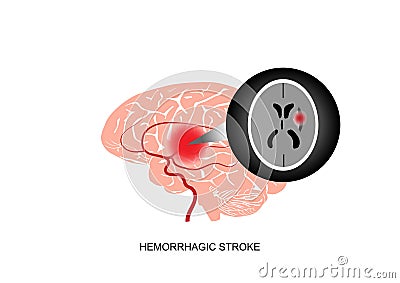 Illustration of cerebral hemorrhagic stroke and brain imaging Vector Illustration