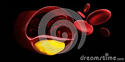 Illustration of blood cells with plaque buildup of cholesterol symbol of vascular illness. isolated Black Stock Photo