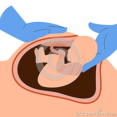 Illustration of C-section or cesarean process Vector Illustration