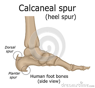 Illustration of Calcaneal spur Vector Illustration