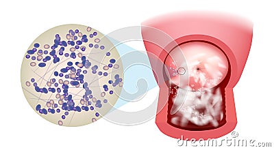 Illustration of a candidiasis infection on the cervix. Vaginal Candidiasis. Candida albicans this infection is also Vector Illustration