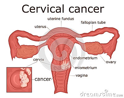 Illustration of cervical cancer Vector Illustration