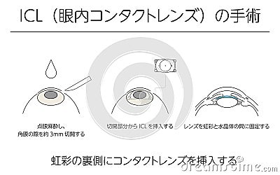 Illustration, Correction of vision with ICL intraocular contact lens, Medical illustration. - Translation: intraocular contact Cartoon Illustration