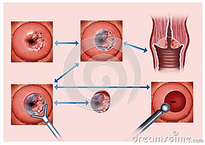 Illustration describing the process of cauterization of the cervix affected by cancer Stock Photo