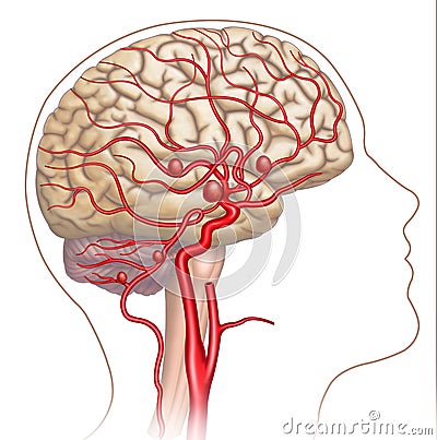 Illustration and descriptive scheme of the aneurysm in the human brain. Cartoon Illustration