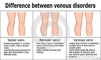 Illustration of difference between venous disorders Vector Illustration