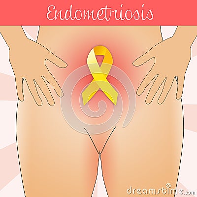 Illustration of Endometriosis in woman Stock Photo