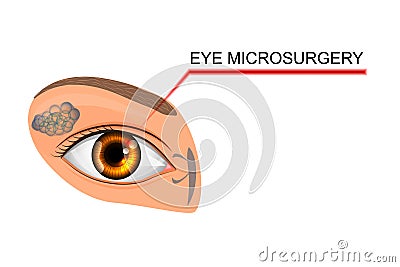 Illustration of the eye, the eyeball. microsurgery Vector Illustration