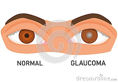 Illustration of eyes with glaucoma. eye diseases. vision loss.World Glaucoma Day. flat vector. Vector Illustration