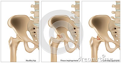 Illustration of the Femoroacetabular Impingement. Different of the Cam impingement and Pincer impingement. Healthy hip Vector Illustration