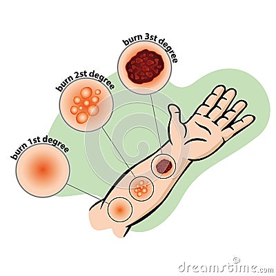 Illustration first aid arm types of burns and injury Vector Illustration