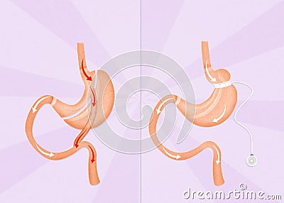 Gastric bypass and gastric band surgery Stock Photo