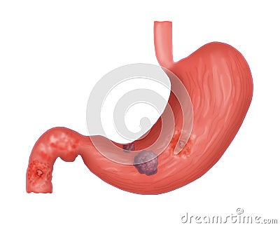 Duodenal cancer helicobacter Stock Photo