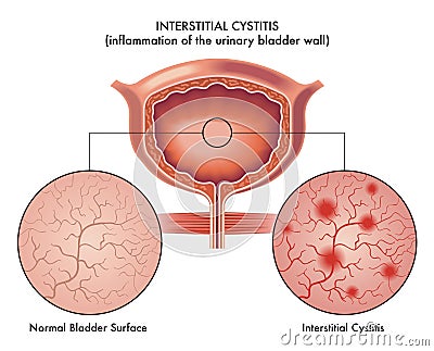 Illustration of interstitial cystitis Vector Illustration