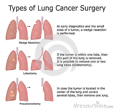 Illustration of lung cancer types Vector Illustration