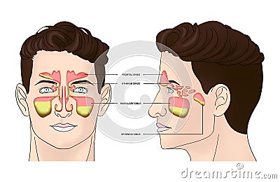 Illustration of man with inflammed paranasal sinuses on white background Stock Photo