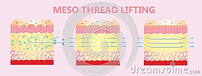 Illustration of meso threads lifting Stock Photo