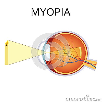 Illustration of myopia. Vector Illustration