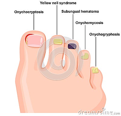 Illustration of nail diseases Cartoon Illustration