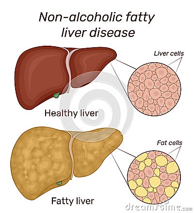 Illustration of non-alcoholic fatty liver disease Vector Illustration