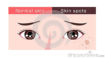 Illustration of normal facial skin and facial skin with spots Vector Illustration