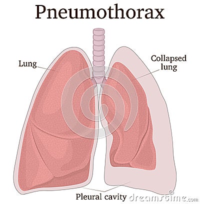Illustration of Pneumothorax Vector Illustration