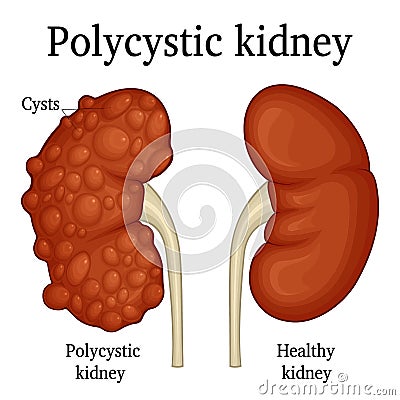 Illustration of polycystic kidney Vector Illustration
