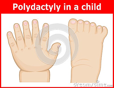 Illustration of Polydactyly in a child Vector Illustration