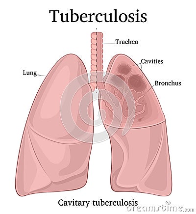 Illustration of pulmonary tuberculosis Vector Illustration