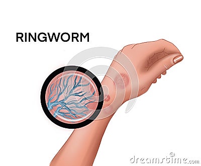 Ringworm on the hand Stock Photo