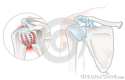 Frozen Shoulder Adhesive capsulitis Illustration. Labeled Cartoon Illustration