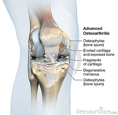 Osteoarthritis of the knee joint, medical illustration Stock Photo