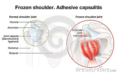 Frozen shoulder. Adhesive capsulitis surgery. Labeled Illustration Stock Photo