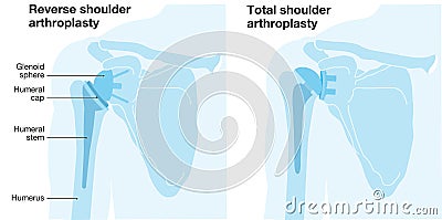 Shoulder arthroplasty. Shoulder replacement. Illustration Stock Photo