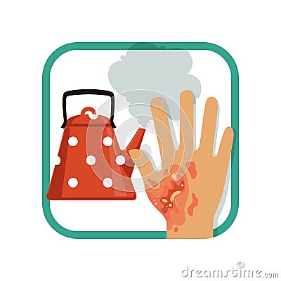 Illustration showing third degree burn of hand. Severe burns skin from kettle Vector Illustration