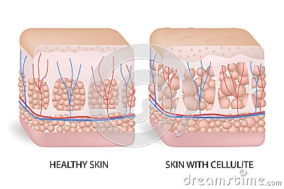 Illustration of skin cross section showing cellulite. The formation of cellulite. Cellulite occurs in most females and Vector Illustration