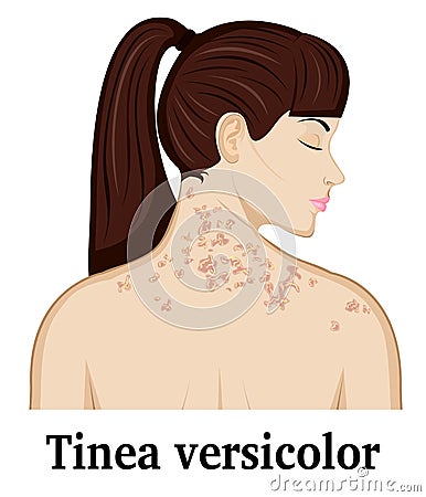 Illustration of Tinea versicolor Vector Illustration