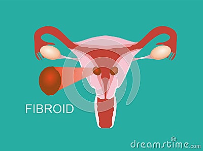 Illustration of the uterine fibroid. Intramural myoma Vector Illustration